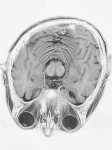 MRI of my skull showing Deformational Plagiocephaly or Deformed or Oblique Skull